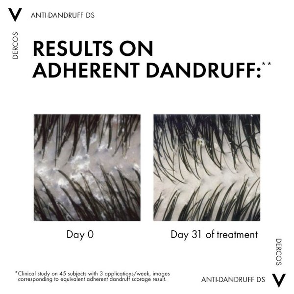 Before and after DERCOS ANTI DANDRUFF DS SHAMPOO FOR NORMAL TO OILY HAIR